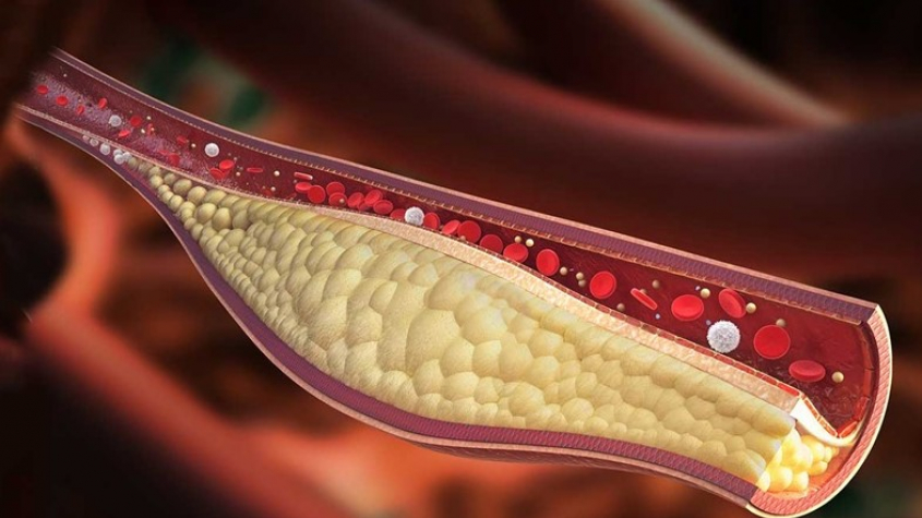 Vysoký cholesterol má sedm z deseti Čechů, může zkrátit život až o deset let