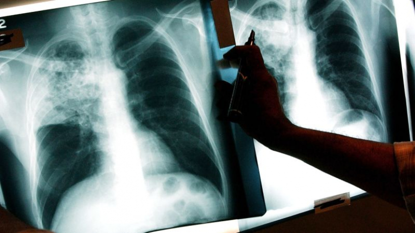 Vzorků s bakteriemi tuberkulózy je víc než loni, důvodem může být migrace z Ukrajiny