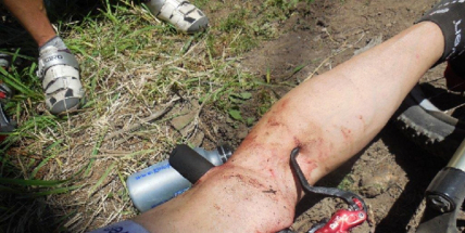 Sport může být nebezpečný. Cyklista si propíchl řídítky stehno