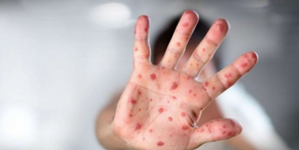 Ve Středočeském kraji přibyly další případy spalniček