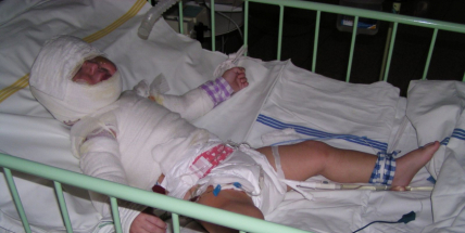 Popálení zanechává jizvy na těle i na duši