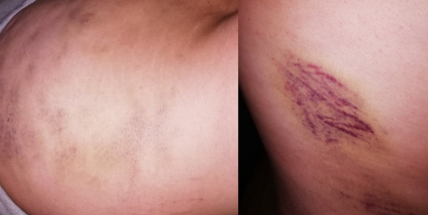 Po masáži byla tři dny nepoužitelná, ještě dnes bere léky