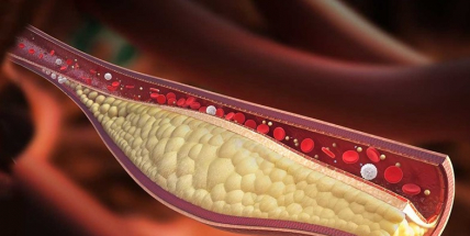 Vysoký cholesterol má sedm z deseti Čechů, může zkrátit život až o deset let