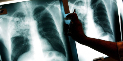 Vzorků s bakteriemi tuberkulózy je víc než loni, důvodem může být migrace z Ukrajiny