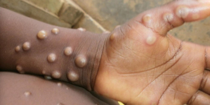 Pokud by se nakupovaly vakcíny proti neštovicím, tak pro celou EU