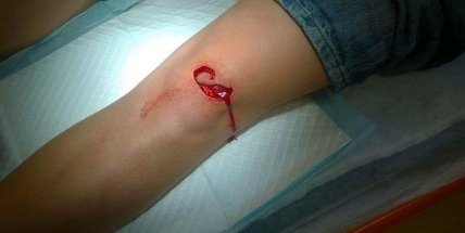 Chlapec se na bazénu pořezal o rozbitou dlaždici