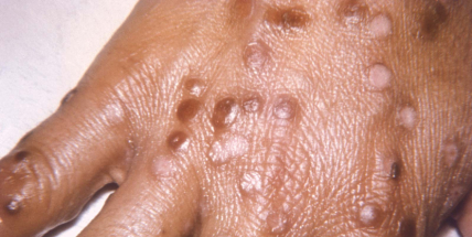 Česko dostane 2800 vakcín proti opičím neštovicím